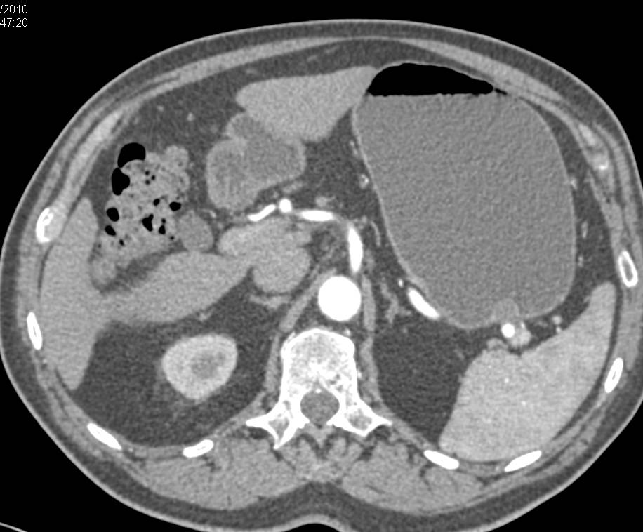 1 cm Gastric GIST Tumor in 3D - CTisus CT Scan