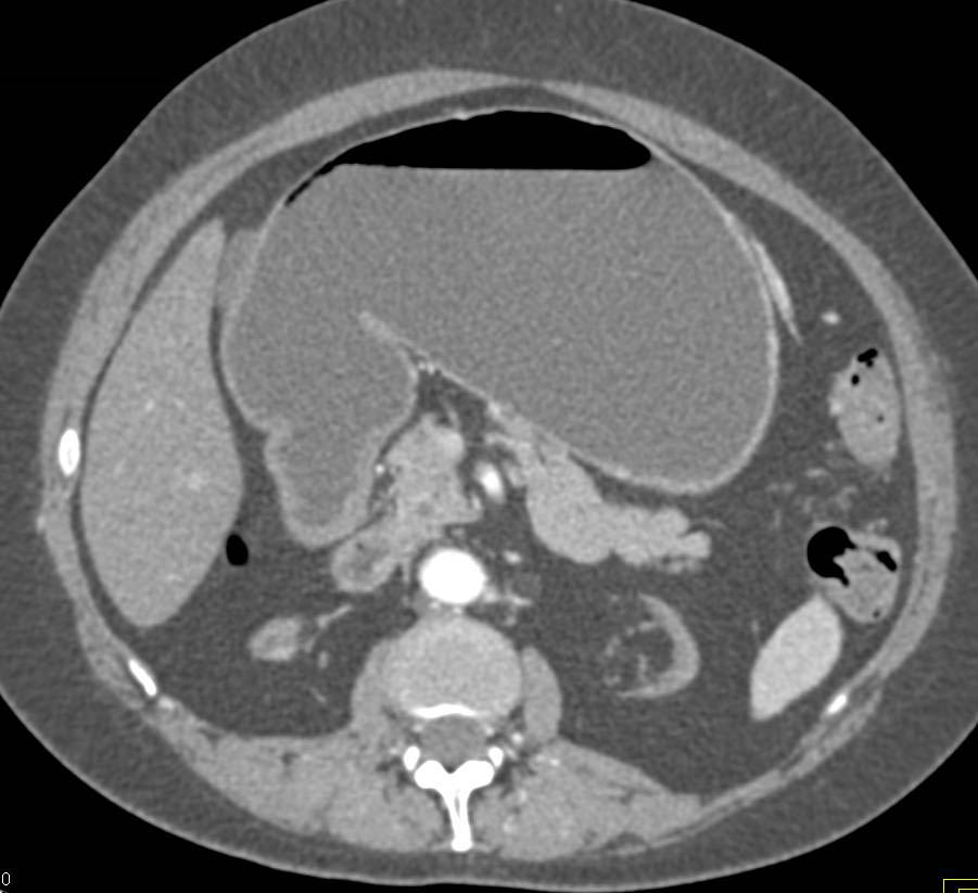 Gastric Outlet Obstruction due to Antral Cancer - CTisus CT Scan