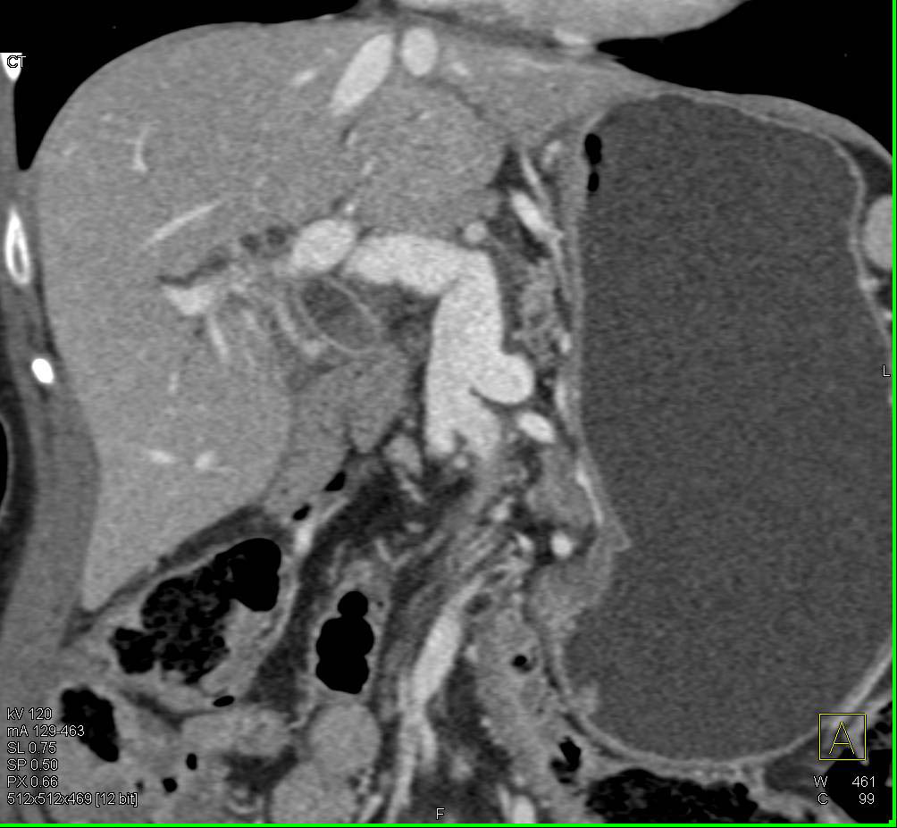 Post Operative Gastric Outlet Obstruction - CTisus CT Scan