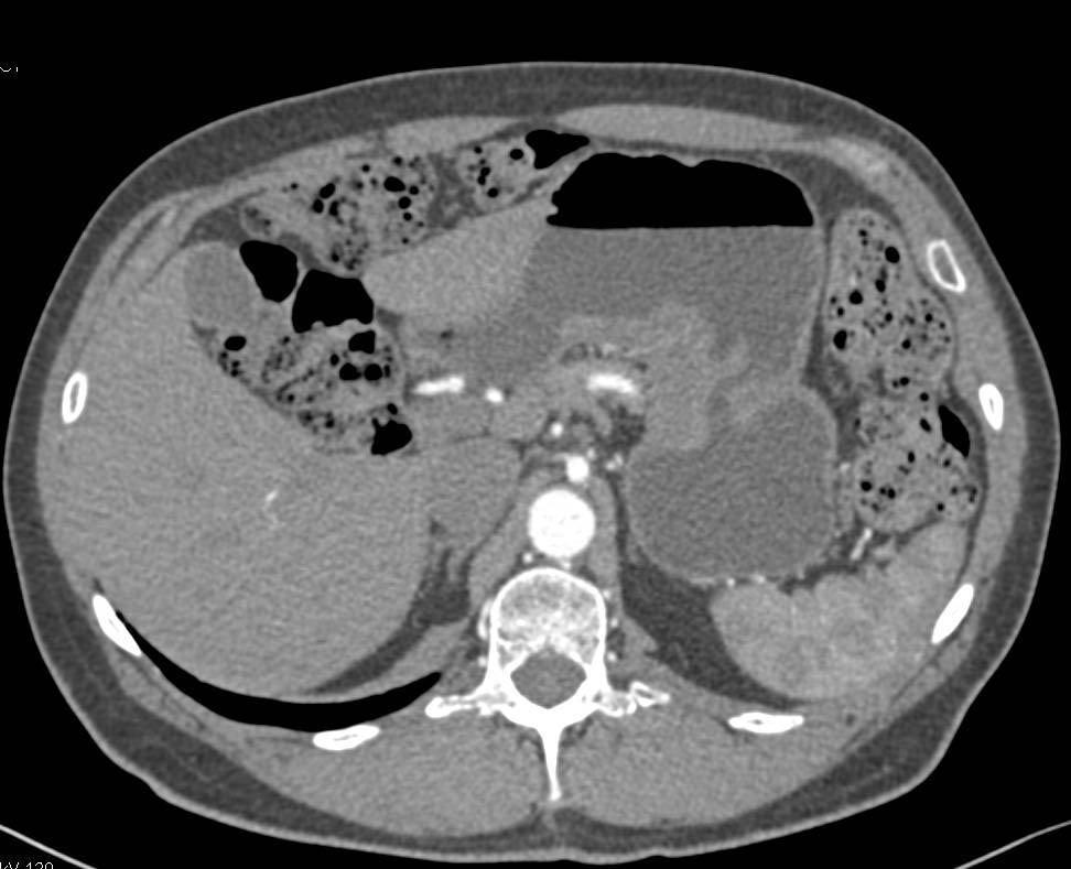 Gastric Adenocarcinoma with Celiac Nodes - CTisus CT Scan