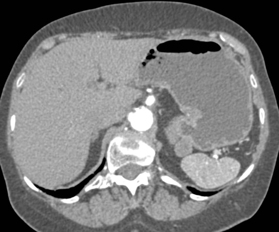 Gastric Adenocarcinoma in the Fundus with Enlarged Node - CTisus CT Scan