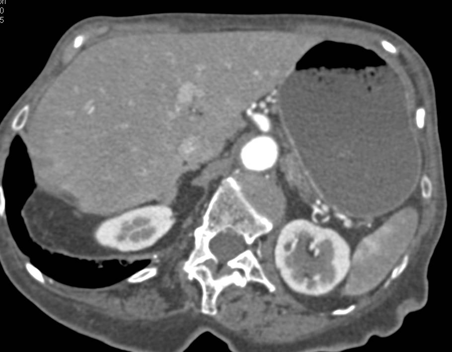 Antral Carcinoma - CTisus CT Scan