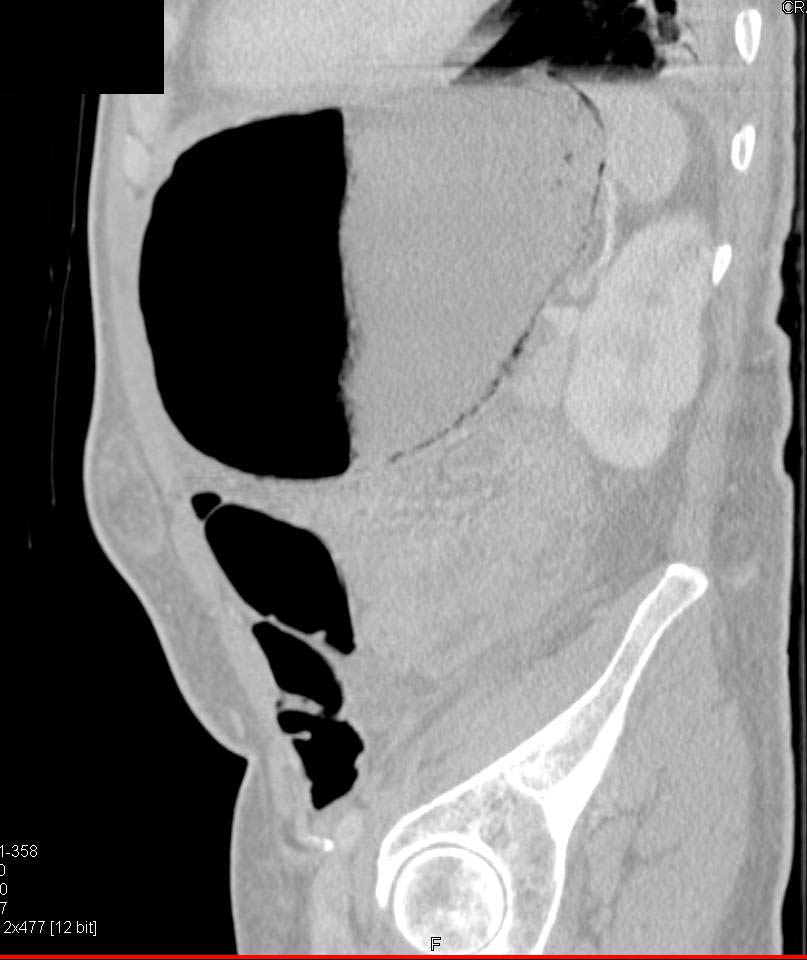 Emphysematous Gastritis - CTisus CT Scan