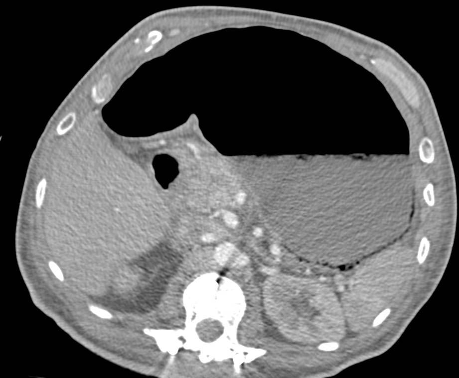 Emphysematous Gastritis - CTisus CT Scan