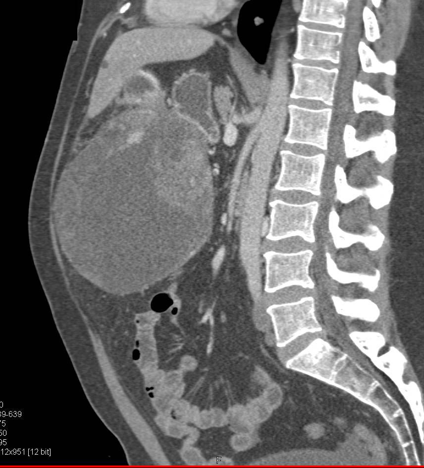 Gastric GIST Tumor - CTisus CT Scan