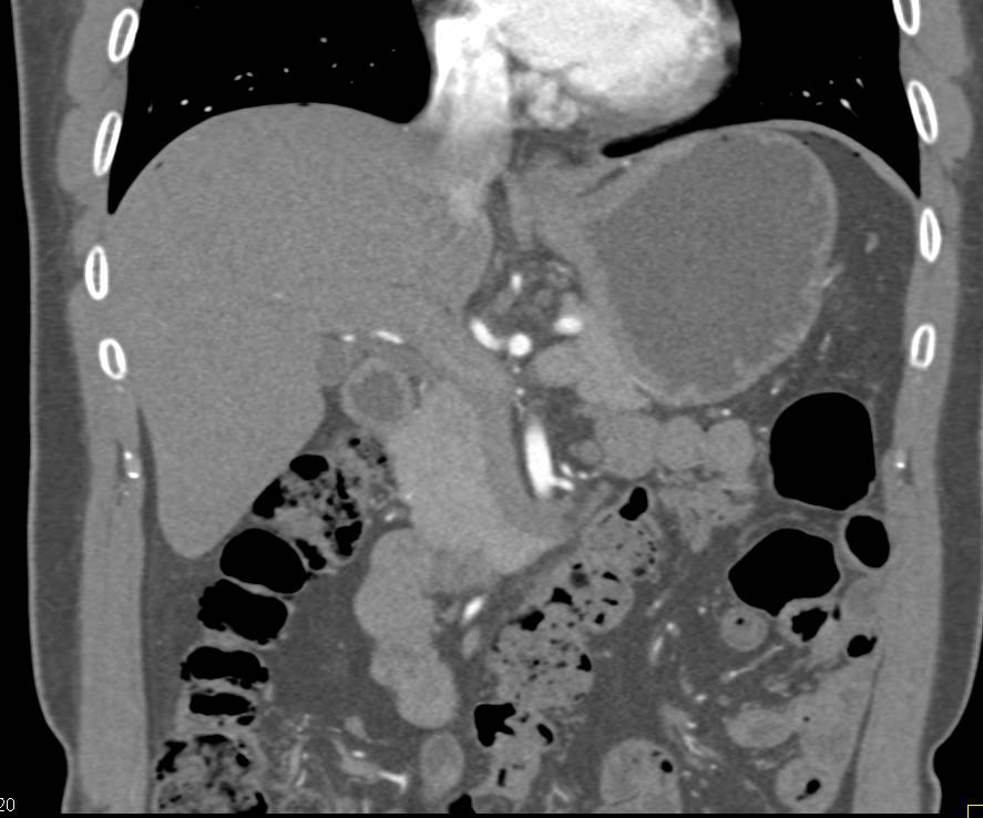 Ulcerating Gastric Cancer - CTisus CT Scan