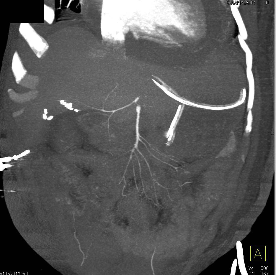 Large Pericardial Effusion and Decreased Vessel Size to Small Bowel with Low Flow State - CTisus CT Scan