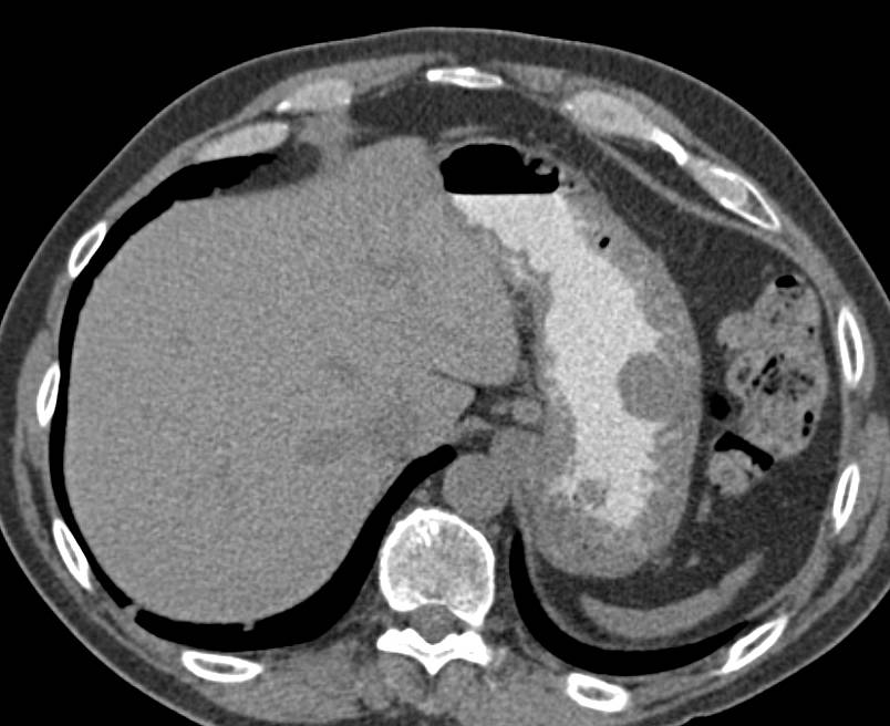 Gastric GIST Tumor is 2 cm - CTisus CT Scan