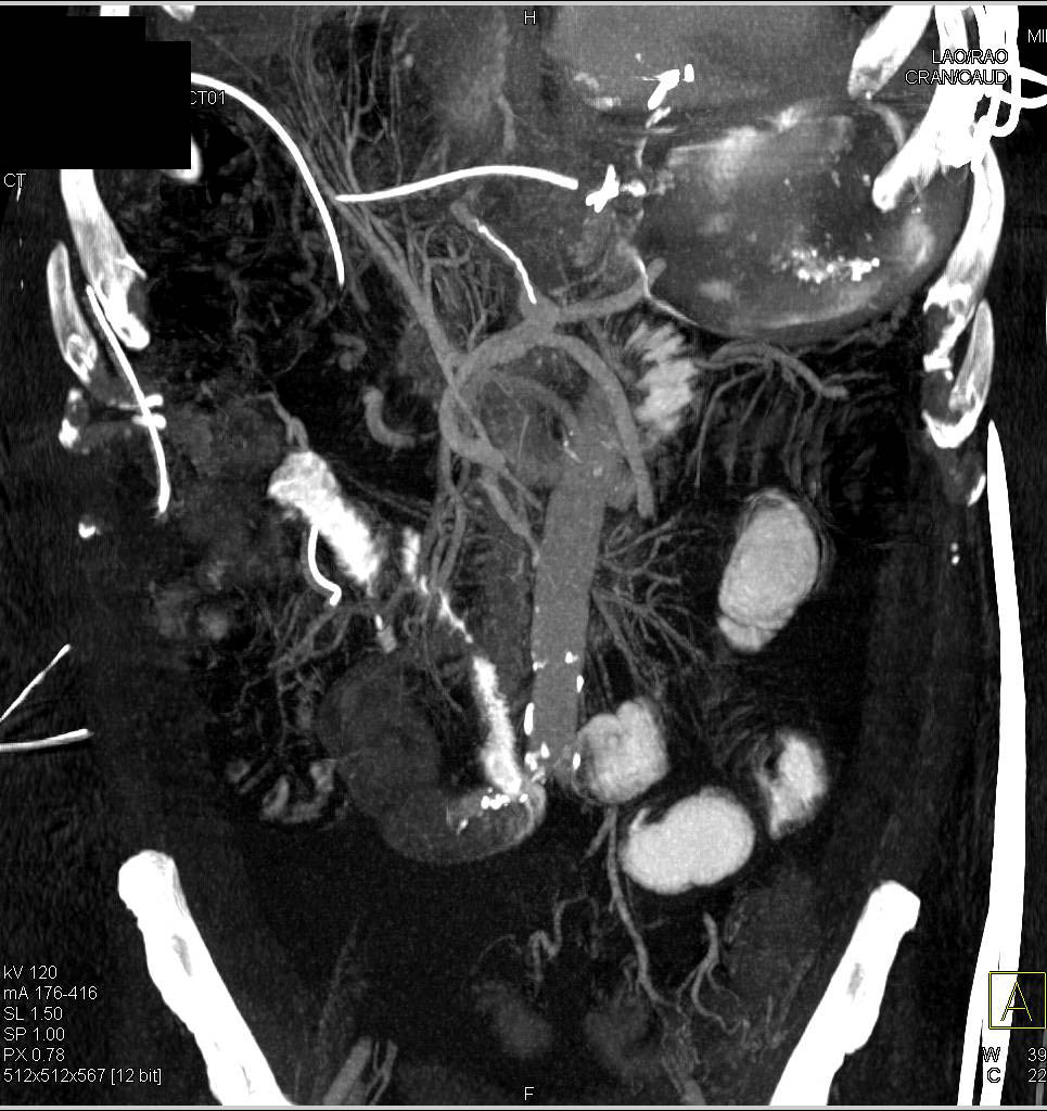 Bulky Gastric Cancer - CTisus CT Scan