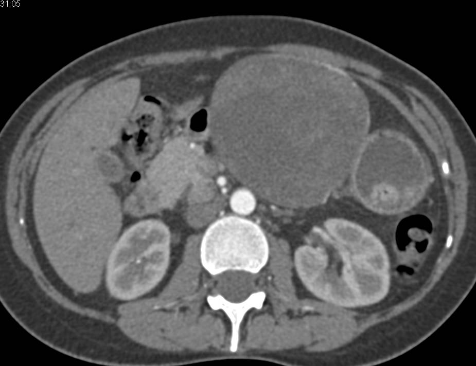 Gastric GIST Tumor - CTisus CT Scan