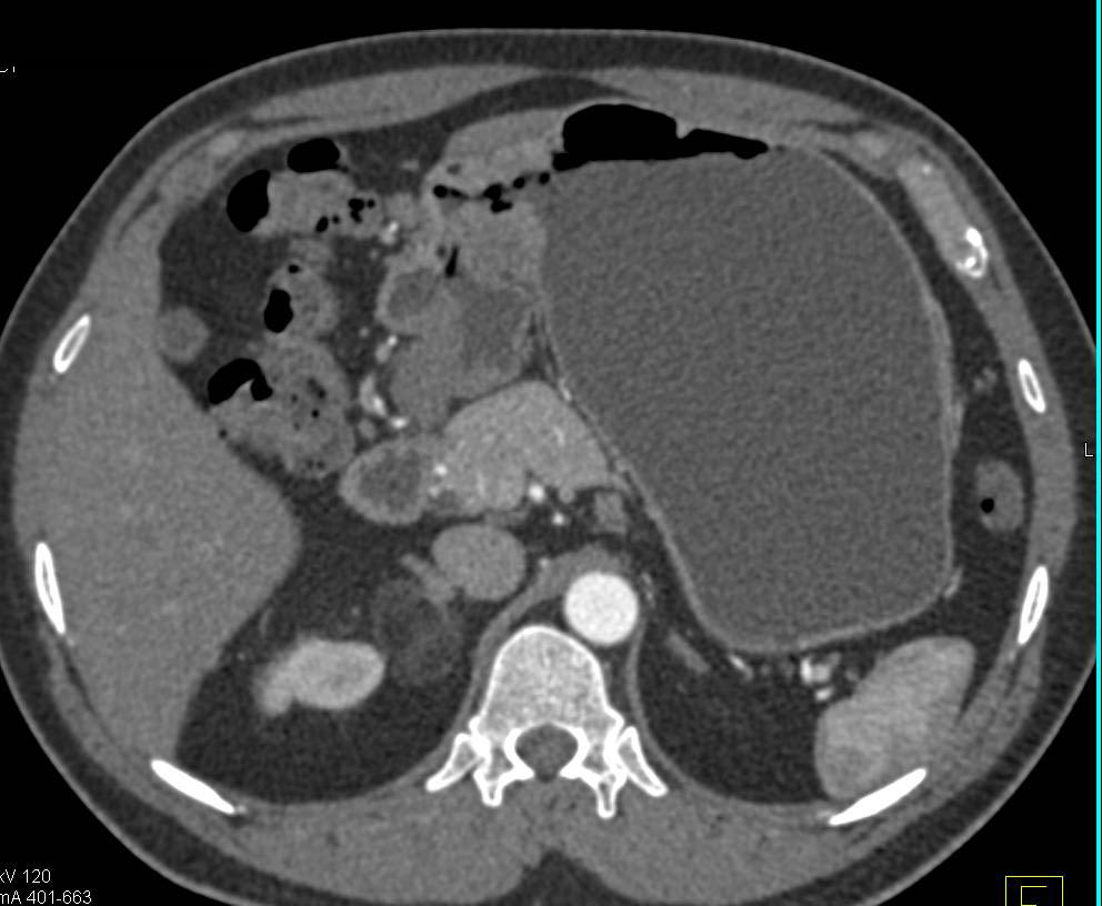 Gastric Adenocarcinoma and Incidental Right Adrenal Angiomyolipoma - CTisus CT Scan