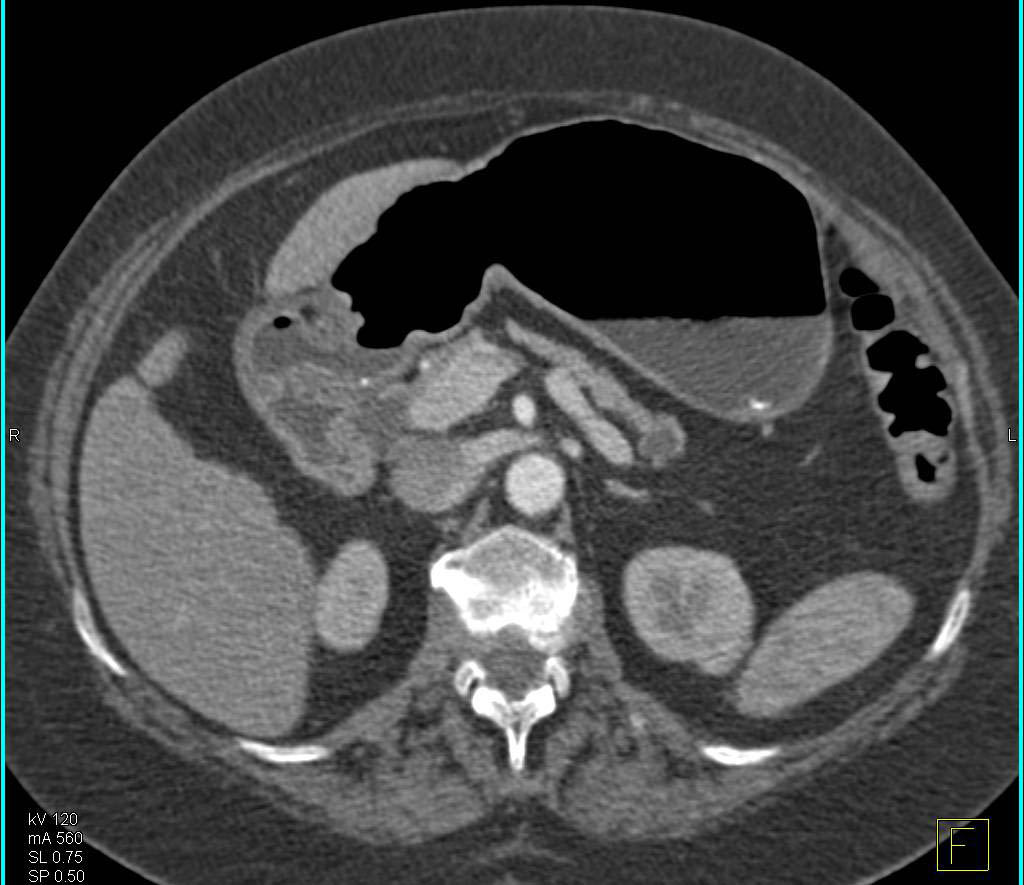 Gastric Cancer with Liver Metastases and Pericardial Effusion - CTisus CT Scan