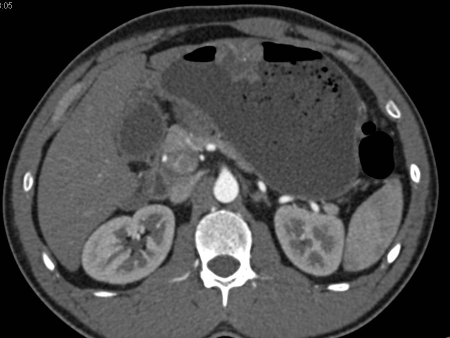 Gastric GIST Tumor is a Polypoid Mass in the Stomach Seen Nicely on 3D - CTisus CT Scan