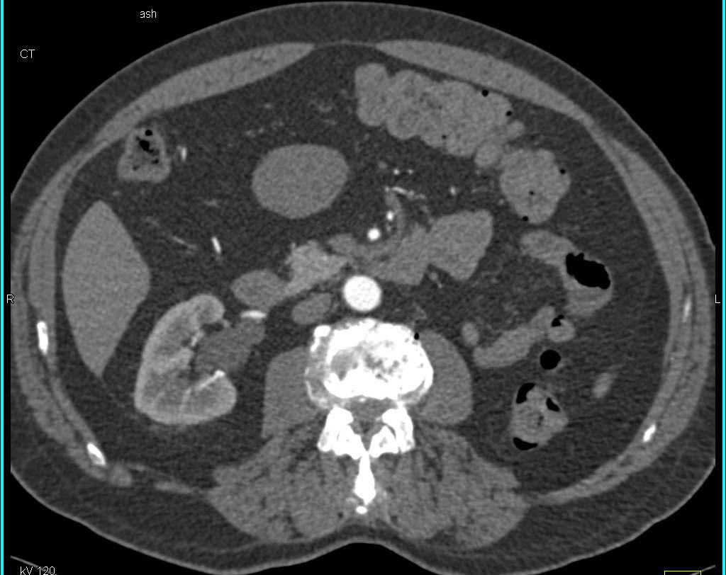 GIST Tumor off Gastric Antrum - CTisus CT Scan