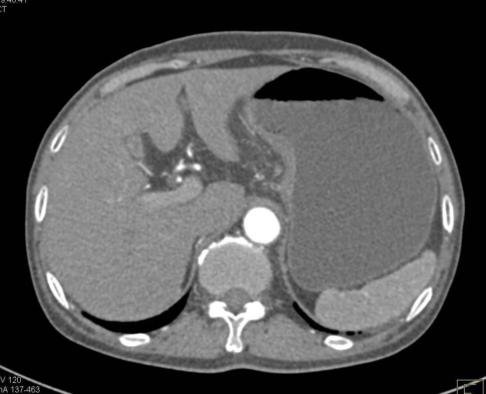 3D Mapping of Antral Carcinoma - CTisus CT Scan