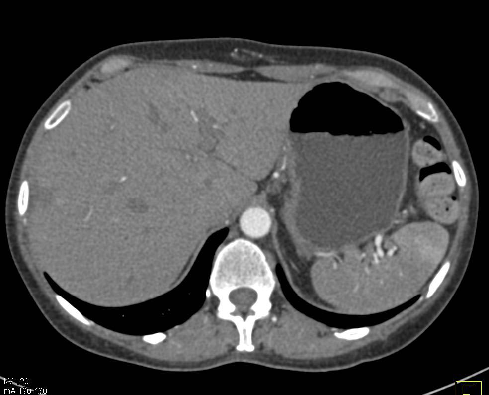 Subtle Gastric Cancer with Liver Metastases - CTisus CT Scan