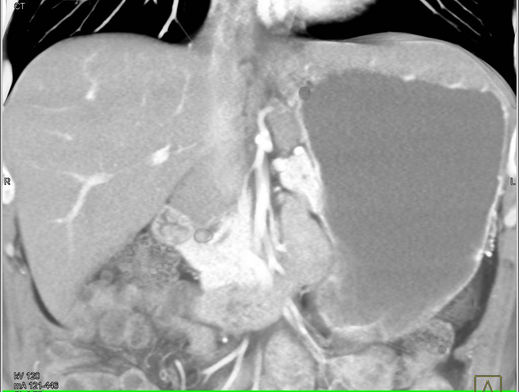 Gastric Adenocarcinoma with Celiac Adenopathy - CTisus CT Scan