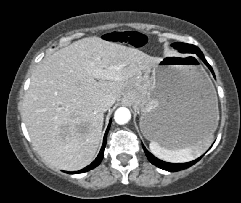 Gastric Adenocarcinoma with Liver Metastases - CTisus CT Scan