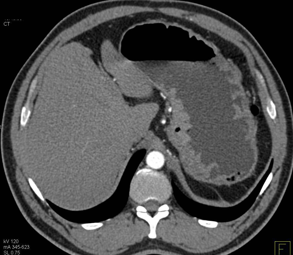 Infiltrating Gastric Adenocarcinoma - CTisus CT Scan