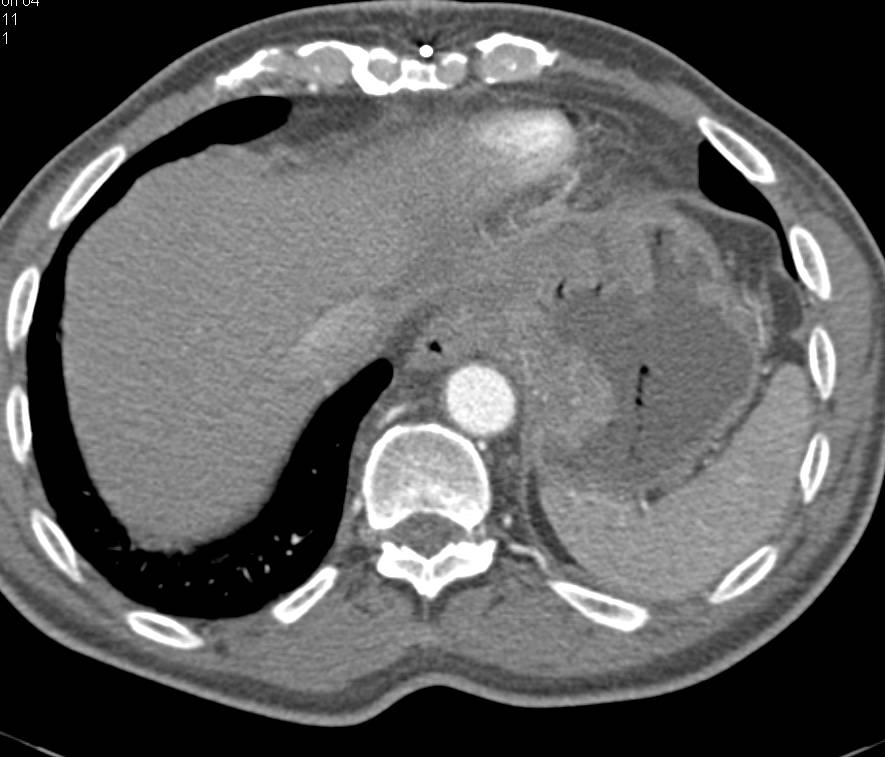 Gastric Adenocarcinoma with Celiac Adenopathy - CTisus CT Scan