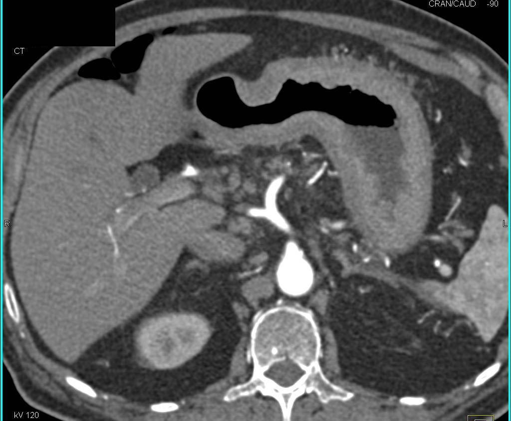 Gastric Adenocarcinoma with Diffuse Infiltration in Various Display Modes - CTisus CT Scan