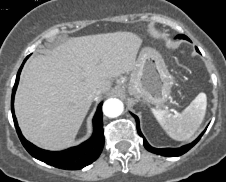 Gastric Adenocarcinoma (Linitis Plastica) with Spread to Omentum and Nodes - CTisus CT Scan