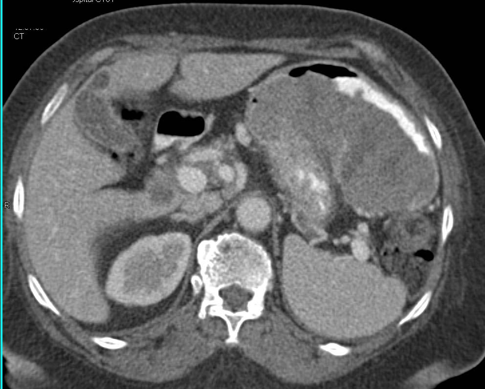 Gastric Ulcerating GIST Tumor - CTisus CT Scan