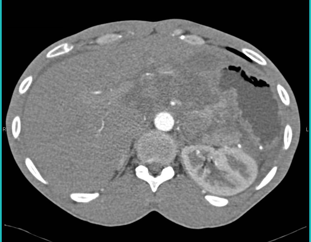 Tumor Infiltration of the Stomach - CTisus CT Scan