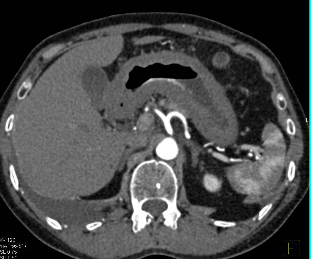 Gastric Adenocarcinoma with Linitis Plastica - CTisus CT Scan