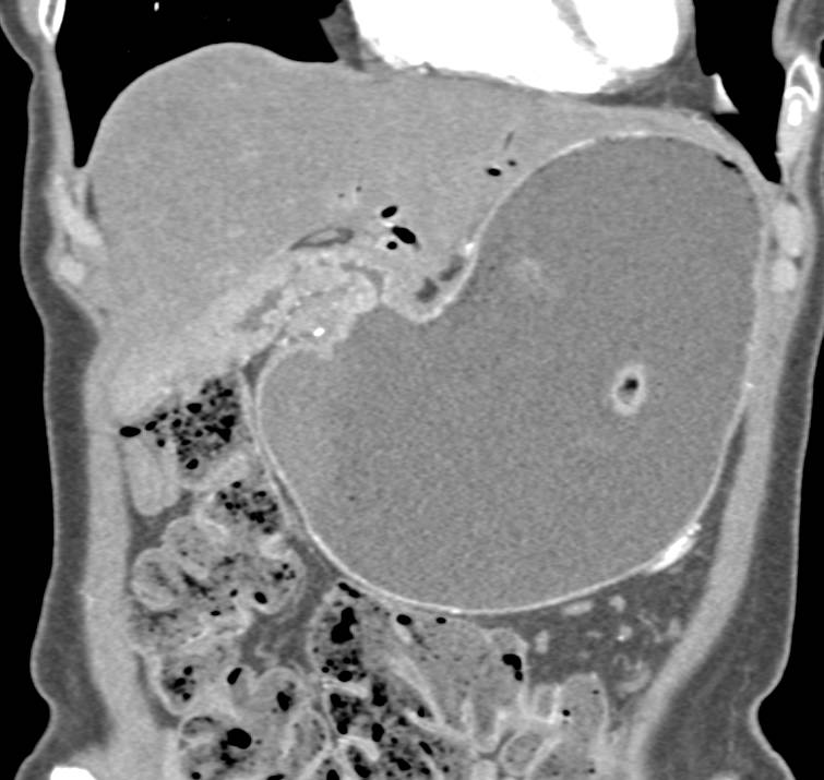 Antral Carcinoma and Gastric Outlet Obstruction - CTisus CT Scan