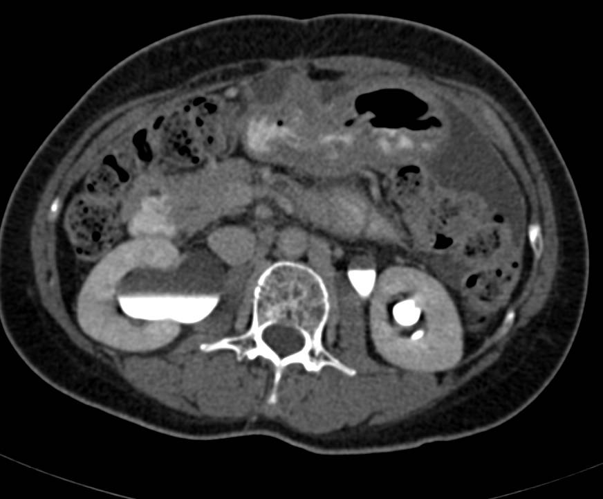 Gastric Cancer with Carcinomatosis - CTisus CT Scan