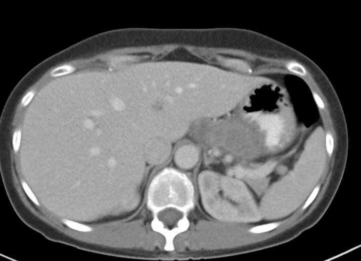 Recurrent Gastric Cancer - CTisus CT Scan