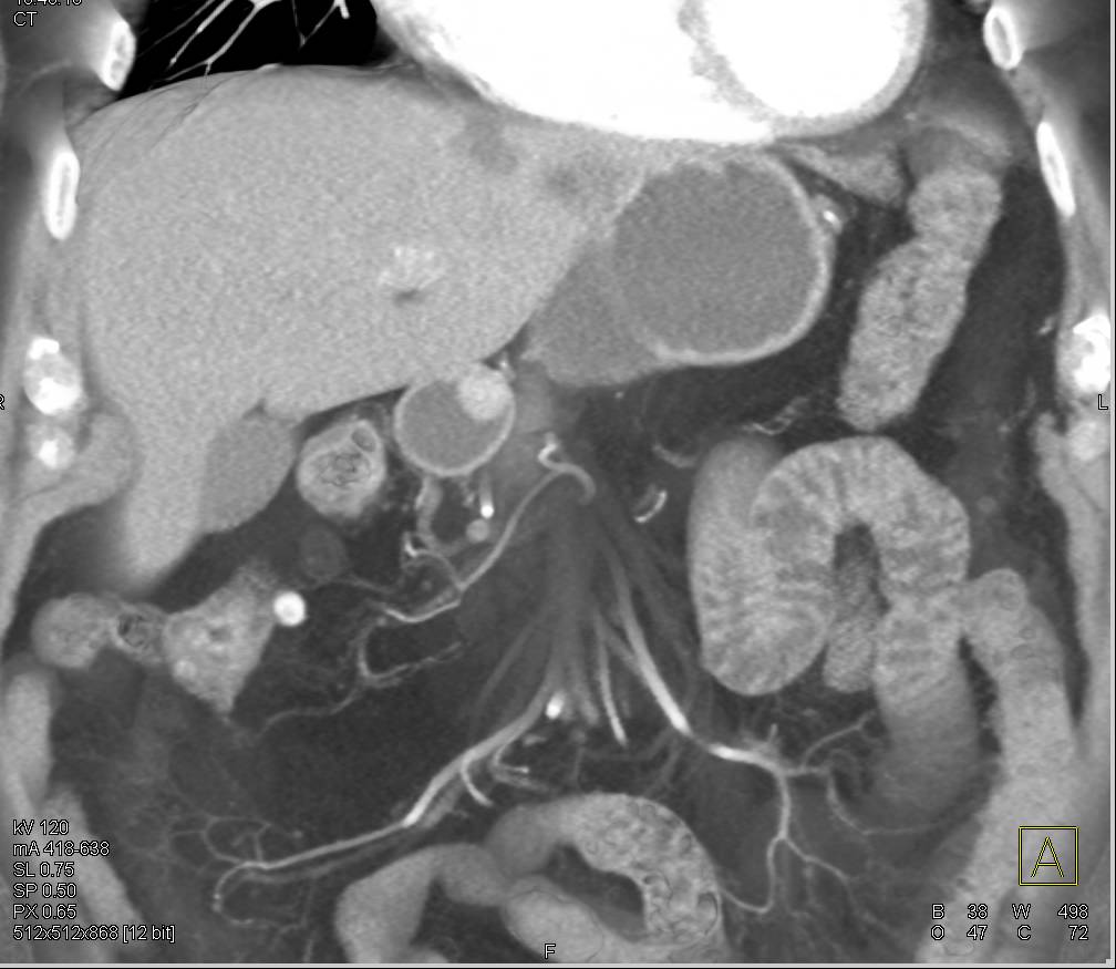 Gastric Carcinoid Tumor - CTisus CT Scan