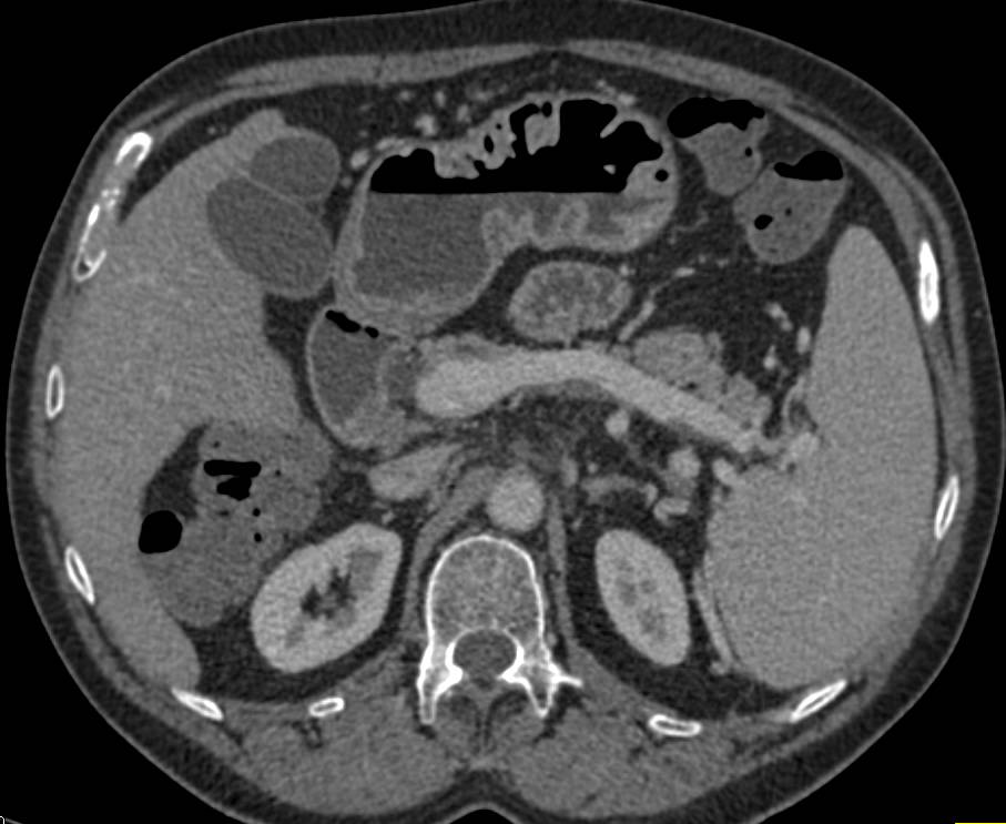 Thickened Gastric Folds - CTisus CT Scan