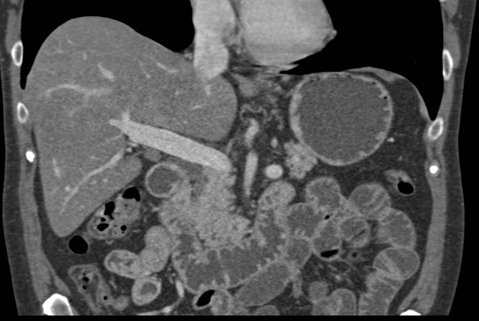 Adenocarcinoma of the Gastroesophageal (GE) Junction - CTisus CT Scan