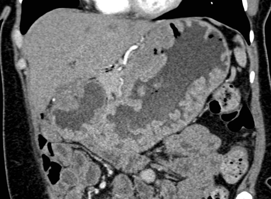 Zollinger-Ellison Syndrome with Enhancing Mass in the Mesentery and Thickened Gastric Folds - CTisus CT Scan