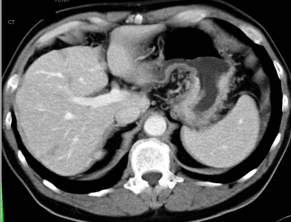 Infiltrating Gastric Cancer in the Fundus of the Stomach - CTisus CT Scan