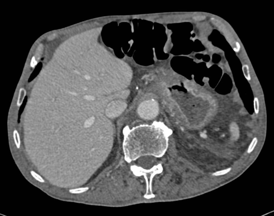 Linitis Plastica Stomach - CTisus CT Scan