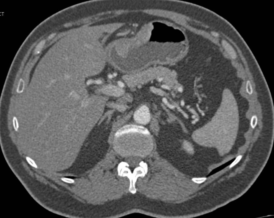 Incidental Gastric Cancer - CTisus CT Scan