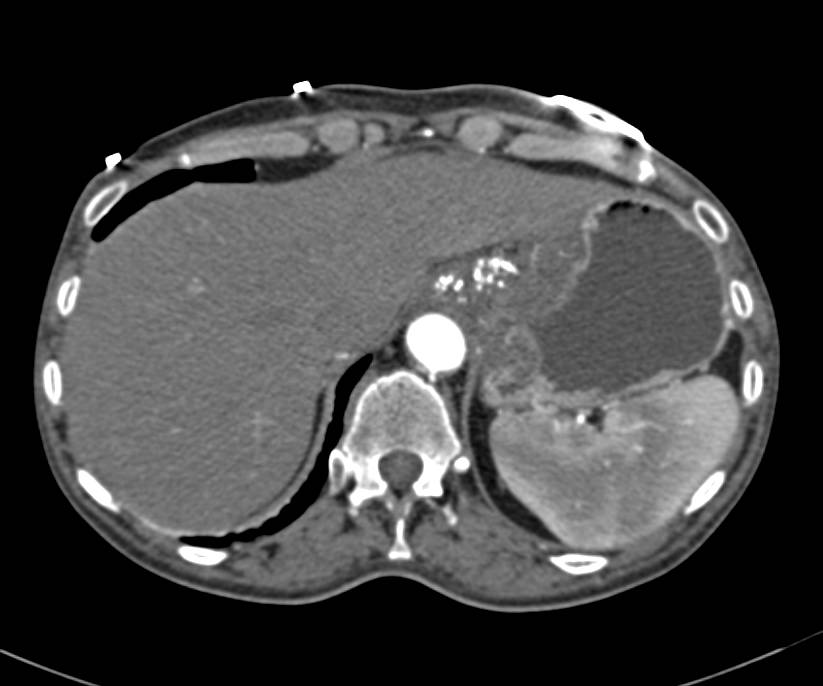 Signet Cell Gastric Adenocarcinoma - CTisus CT Scan