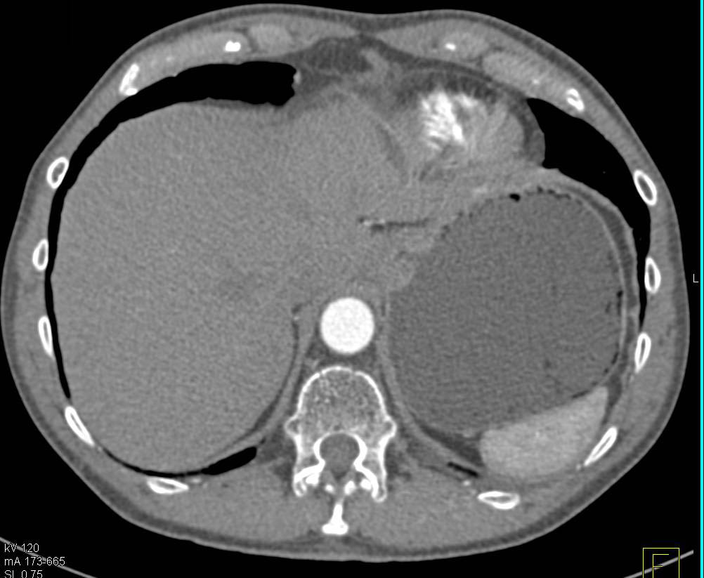 Delayed Gastric Emptying S/P Whipple's Procedure - CTisus CT Scan