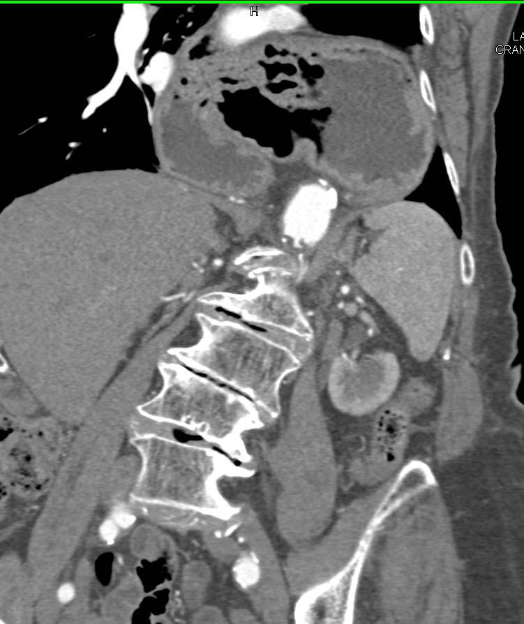 Large Paraesophageal Hiatal Hernia - CTisus CT Scan