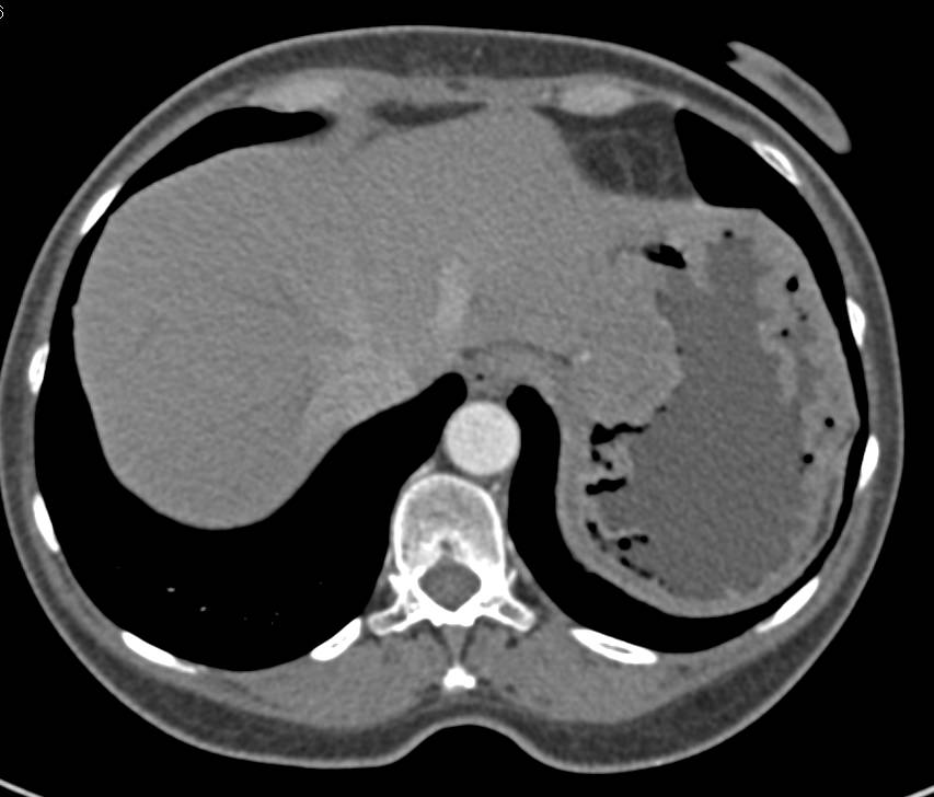 Zollinger-Ellison Syndrome with Thickened Gastric Folds - CTisus CT Scan