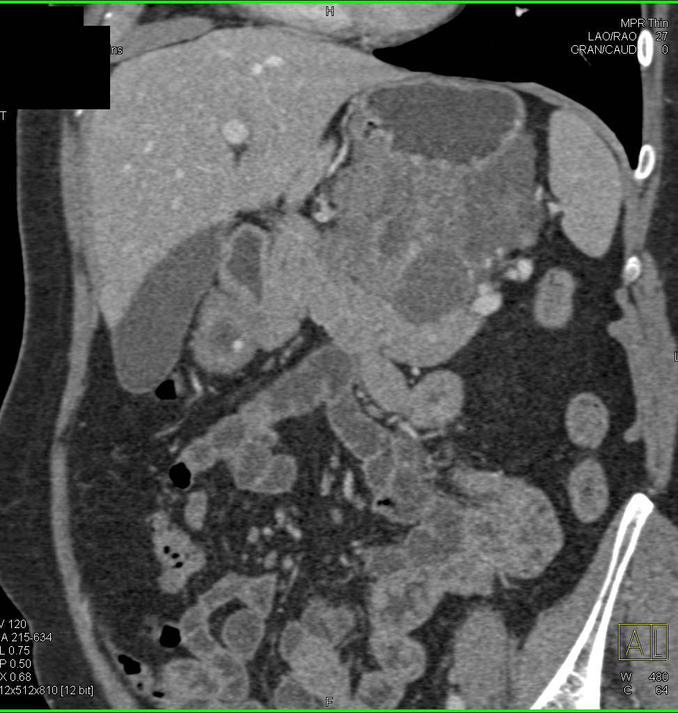 Ulcerating Gastric GIST Tumor - CTisus CT Scan