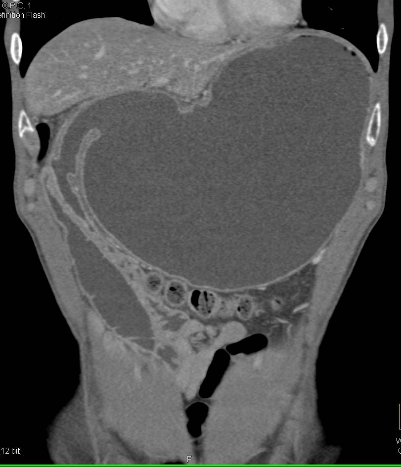 Gastric Outlet Obstruction - CTisus CT Scan