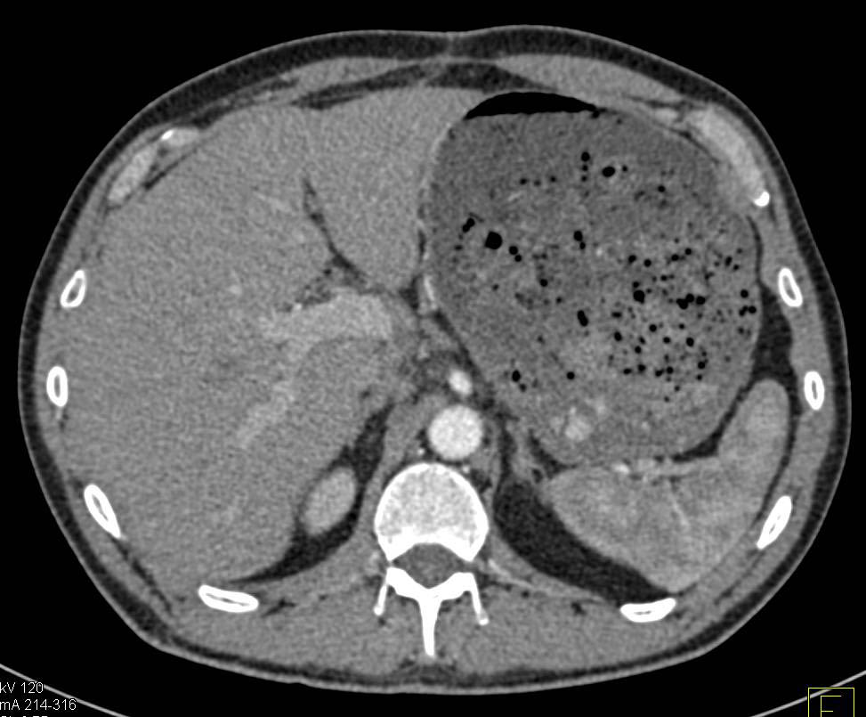 Antral Carcinoma with Delayed Gastric Emptying - CTisus CT Scan