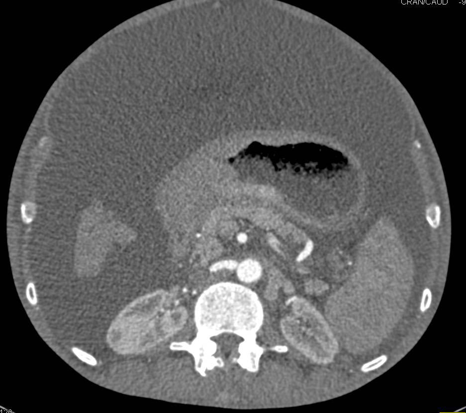 gastric cancer with ascites