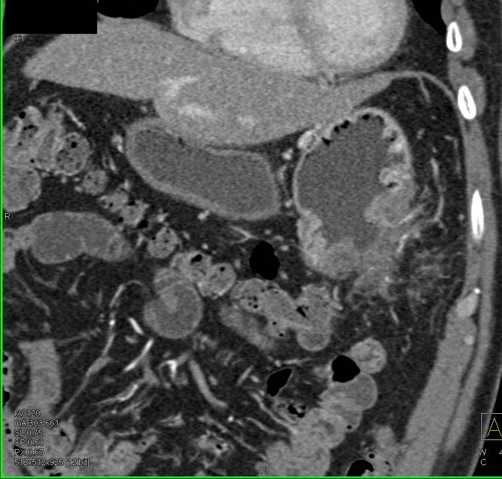 Gastric Cancer with Early Fistualization to the Splenic Flexure - CTisus CT Scan