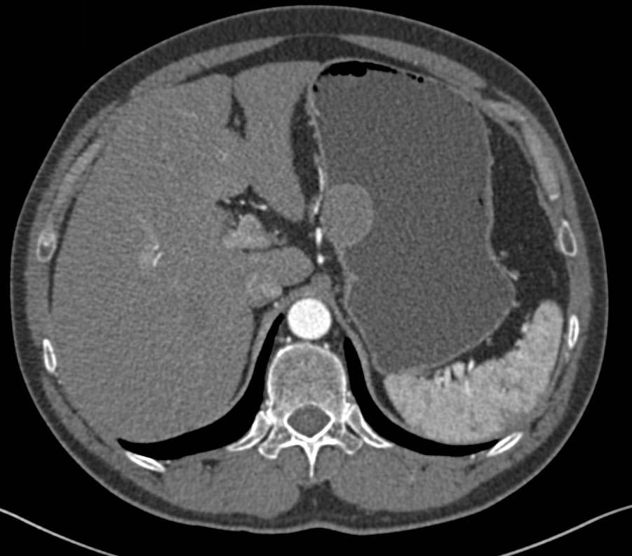 3D of Gastric GIST Tumor - CTisus CT Scan