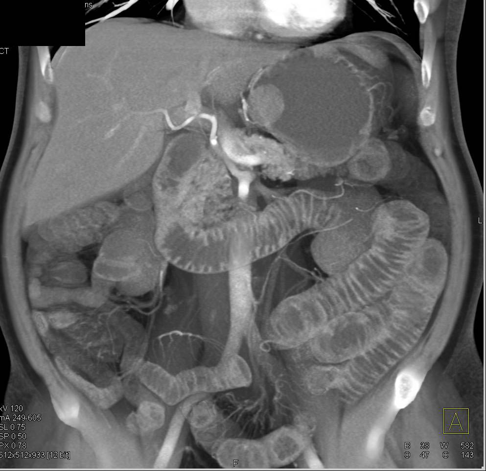 Gastric GIST Tumor - CTisus CT Scan